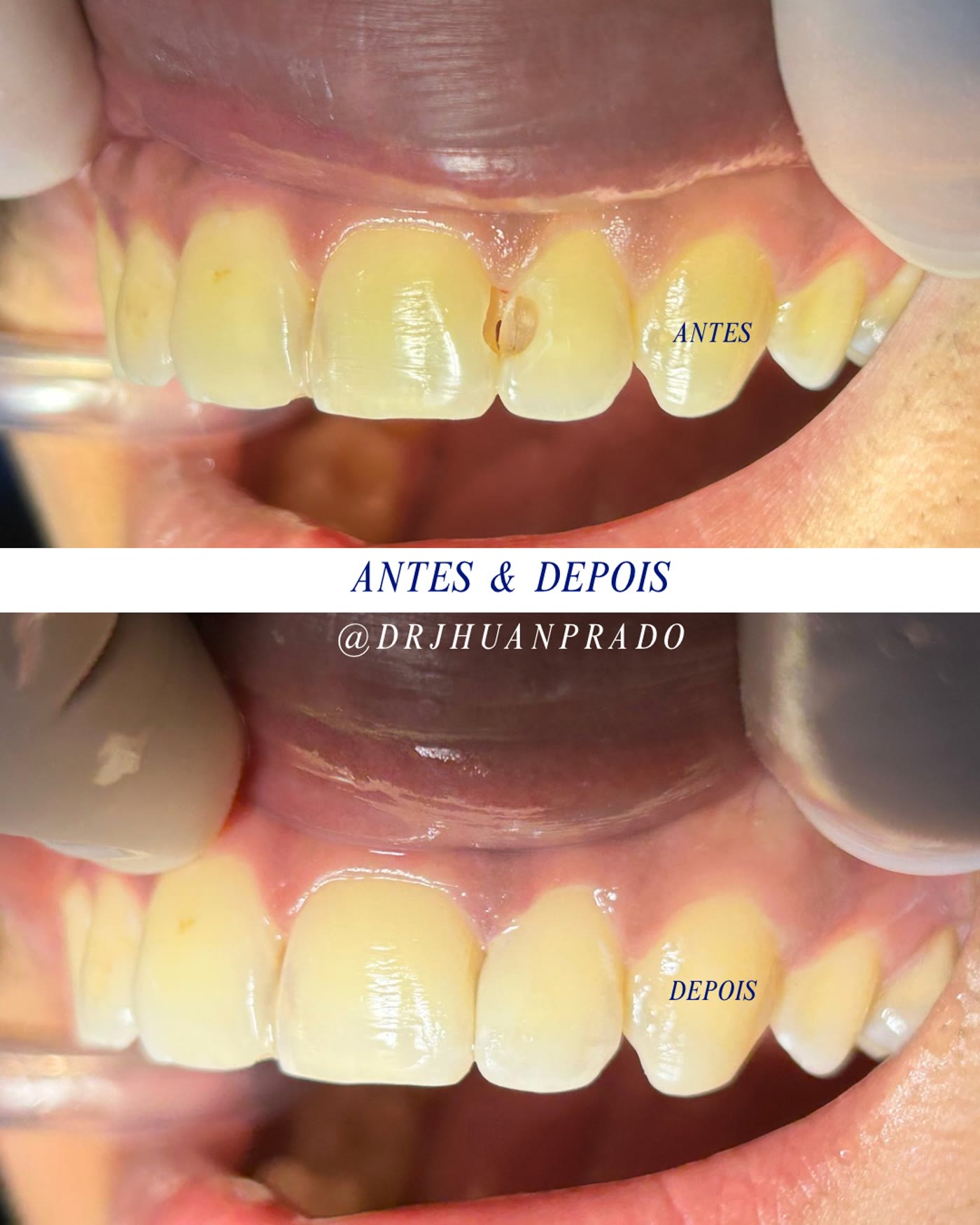 Antes e depois de restauração dentária